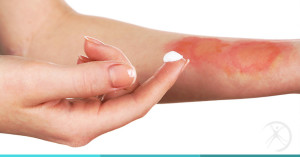 queimaduras-cirurgia-plastica-reparadora-dr-fernando-rodrigues-bh